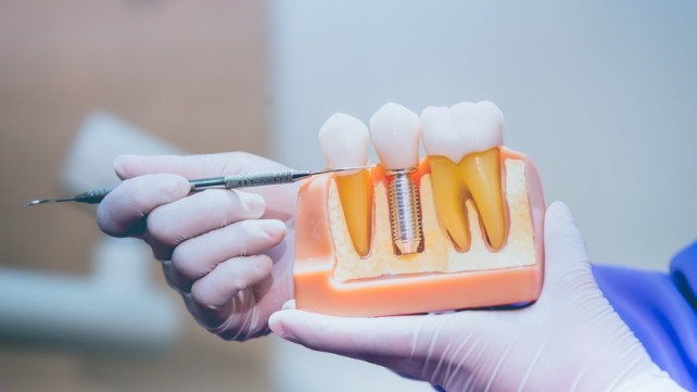 Model of teeth compared to dental implant supported dental crown