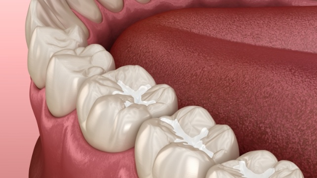 Animated smile with tooth colored fillings after restorative dentistry