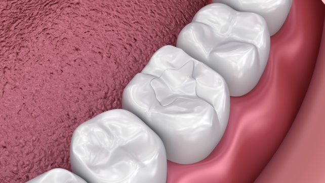 Animated smile with dental sealants