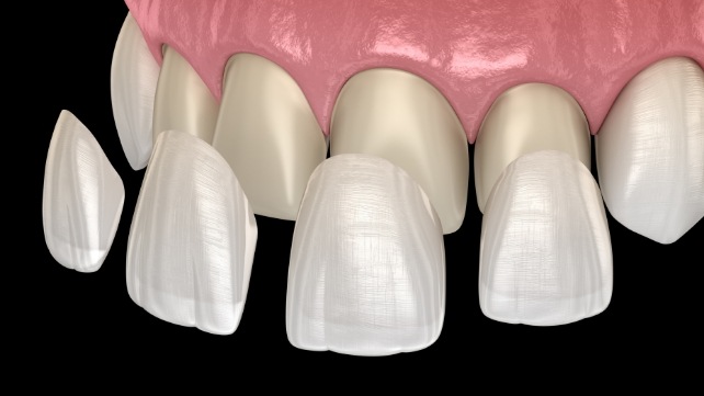 Animated smile during cosmetic dental bonding treatment