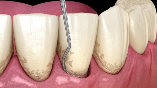 Animated smile during periodontal therapy