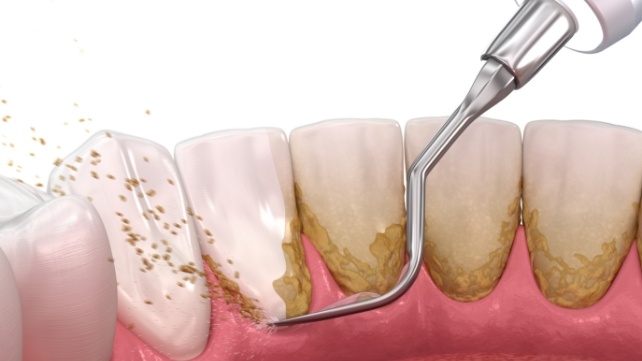 Animated smile during scaling and root planing treatment