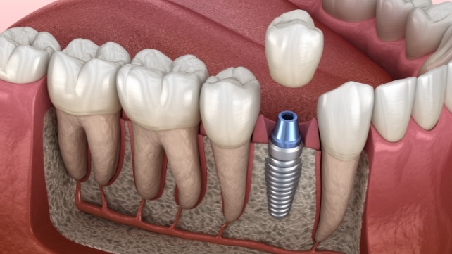 Animated smile during dental implant supported dental restoration placement