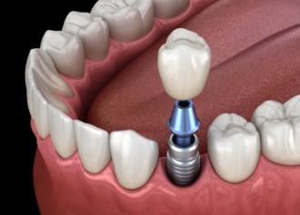 Animated smile during dental implant supported dental crown placement