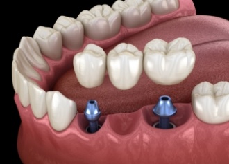 Animated smile during dental implant supported fixed bridge placement