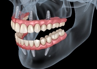 Animated smile during dental implant supported denture placement