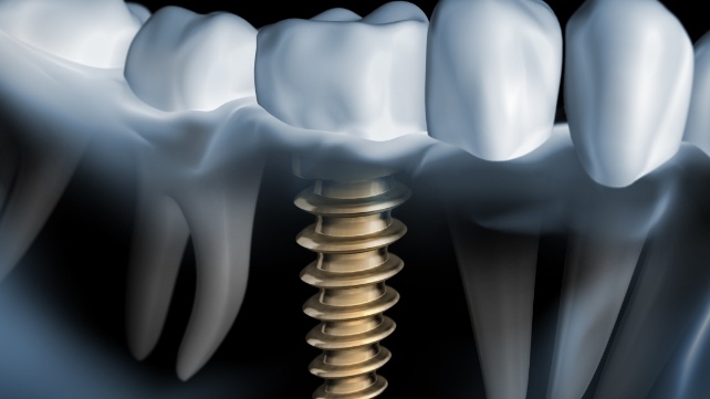 Animated smile with dental implant supported dental crown