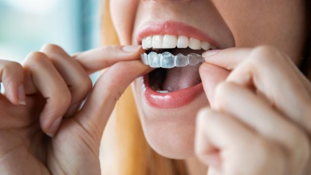 Closeup of dental patient placing a Sure Smile clear aligner